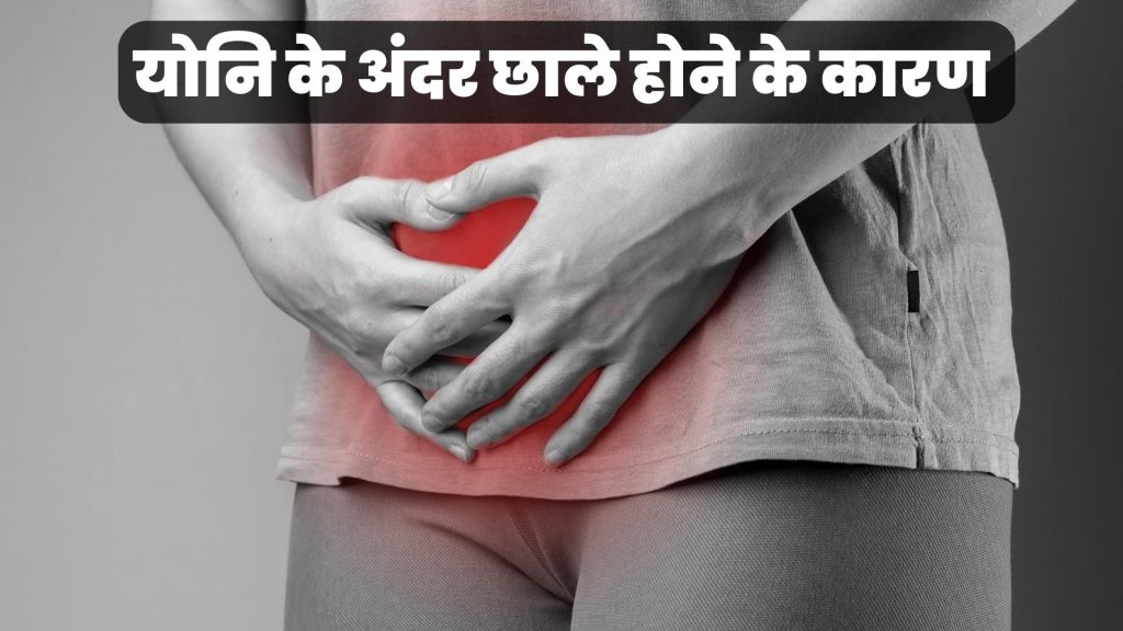 योनि के अंदर छाले होने के कारण