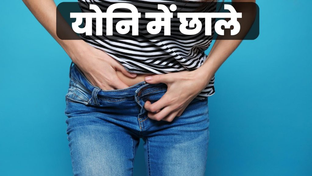 योनि में छाले
