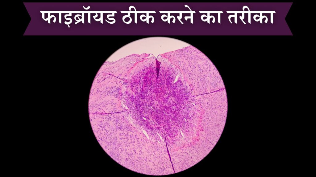 फाइब्रॉयड ठीक करने का तरीका
