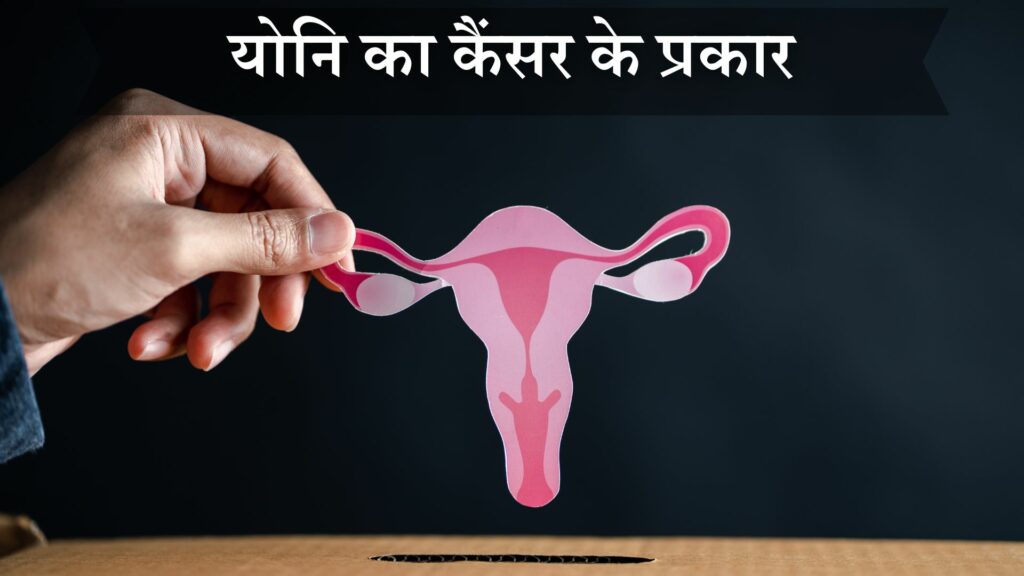 योनि का कैंसर के प्रकार