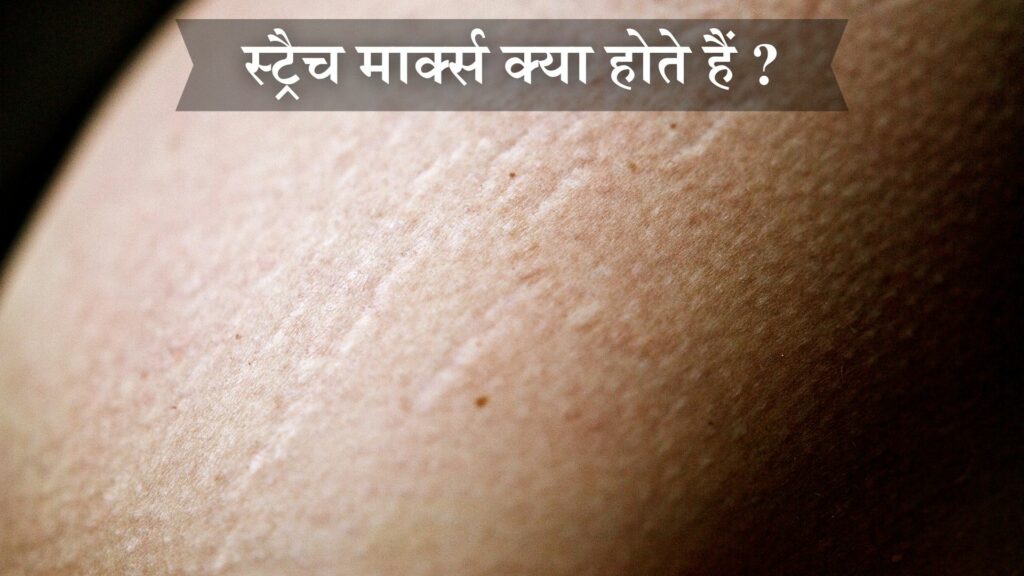 स्ट्रैच मार्क्स क्या होते हैं